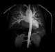 CT: Angiogram of the aorta