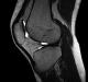 MRI: Knee