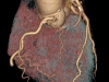CTA: Coronary (Heart)